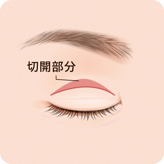 全切開法（まぶたの上のたるみ取り）