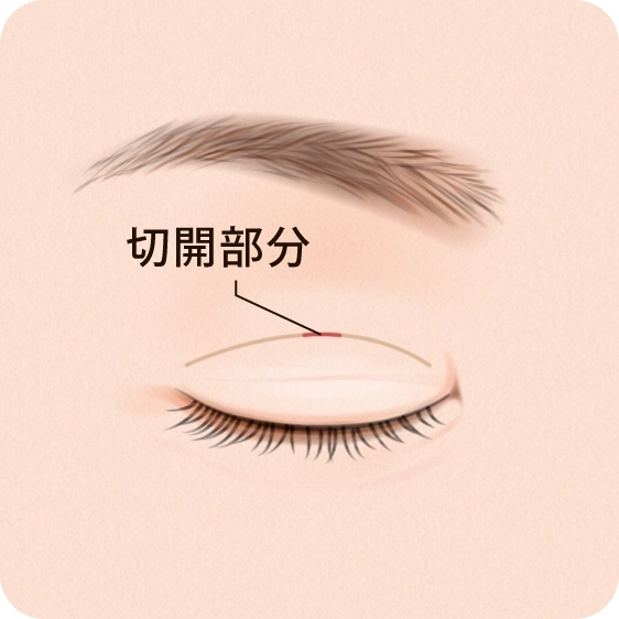 部分切開法