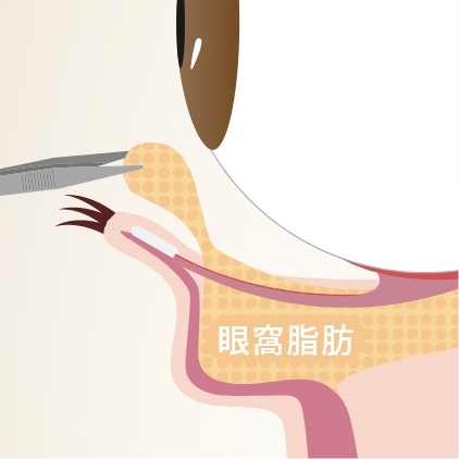 切らないクマ取り（経結膜脱脂法）