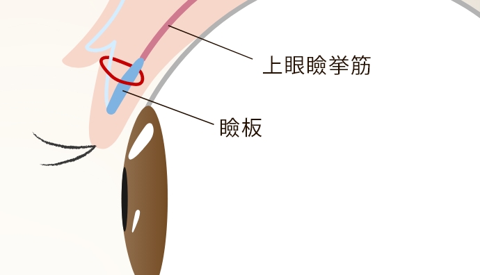 瞼板法