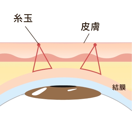 2点留め