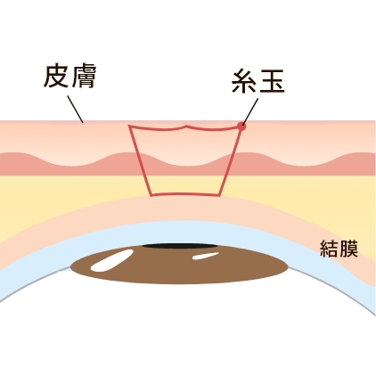 シングルループ