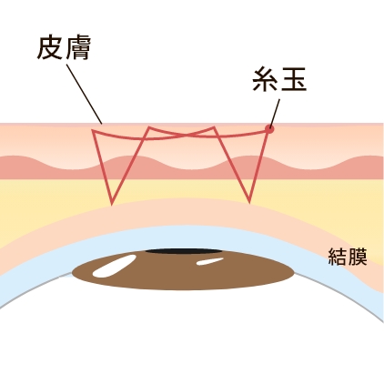 線留め