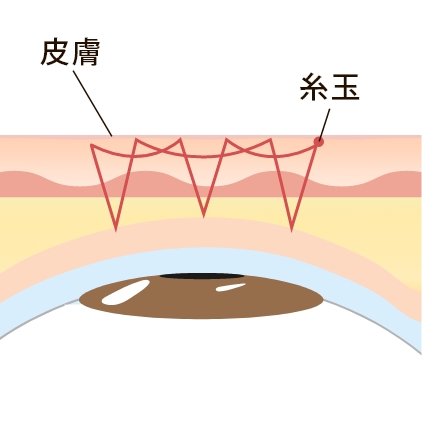 自然癒着法