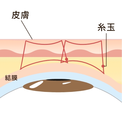 下眼瞼脱脂法