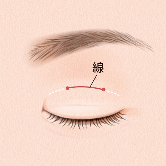 線留め