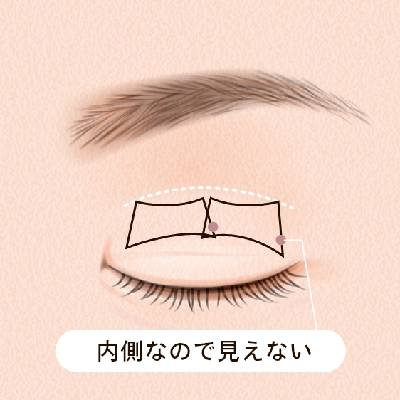 下眼瞼脱脂法