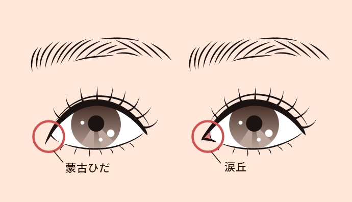 蒙古ひだとは