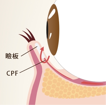 下まぶたの結膜から、CPFと瞼板に糸を通します。