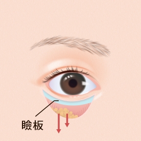 脂肪を下方向へずらします。